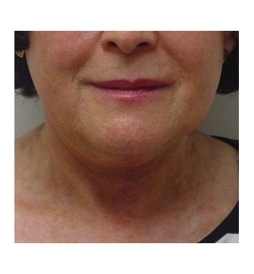 neck lift with correction platysma bands